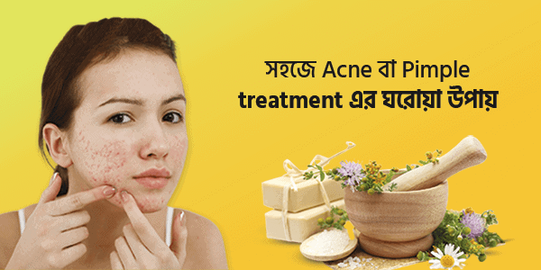 how-to-treat-acne-or-pimple-at-home