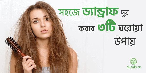 Top 3 Home Remedies for Dandruff