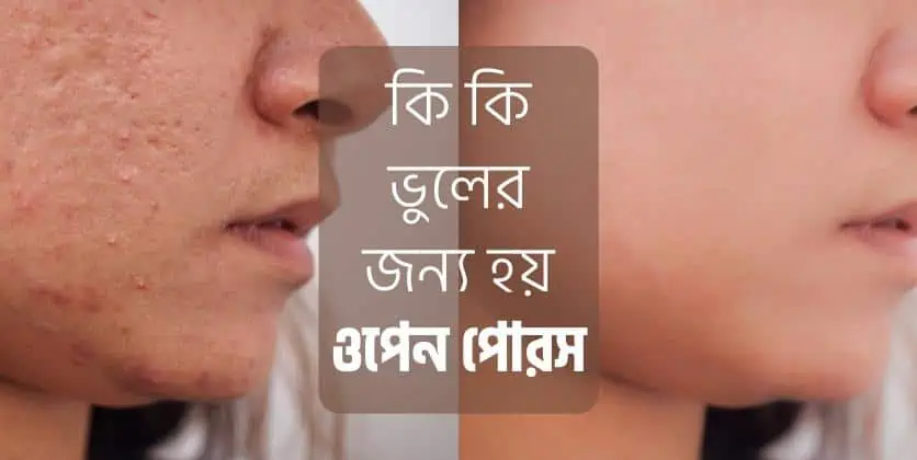 কোন ভুলের কারণে ওপেন পোরস হয়